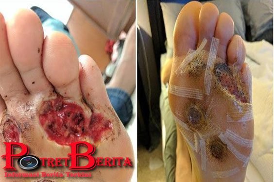 Mandi Tanpa Menggunakan Alas Kaki Di Gym, Kaki Pria Ini Bolong