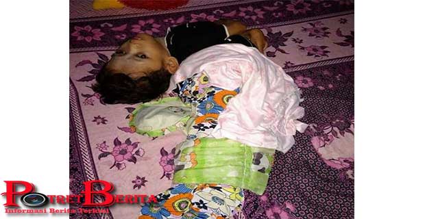 Sejak 3 Tahun Bocah Ini Terbujur Kaku..